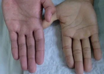 Apa Itu Anemia Aplastik